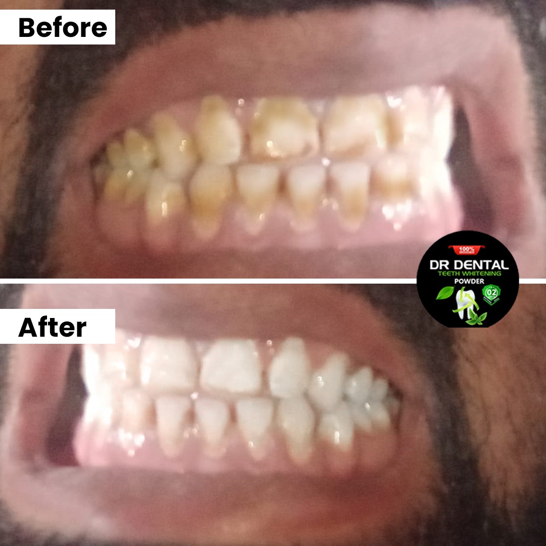 Dr Dental customer result — Cigarette stains gone!