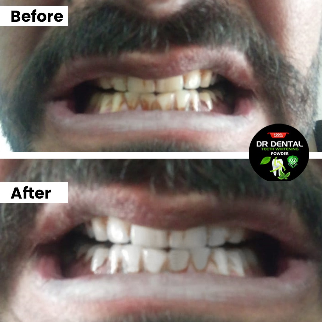 Dr Dental customer result — Best for Gutka stains